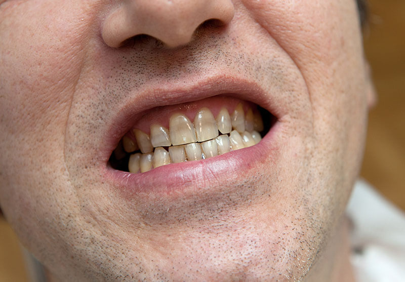 Stained and Discoloured Teeth