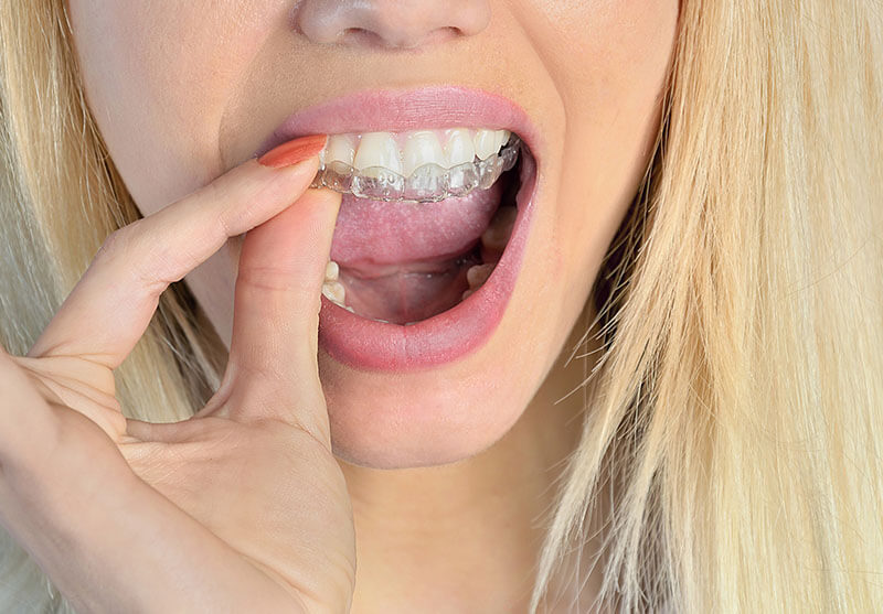 Invisalign