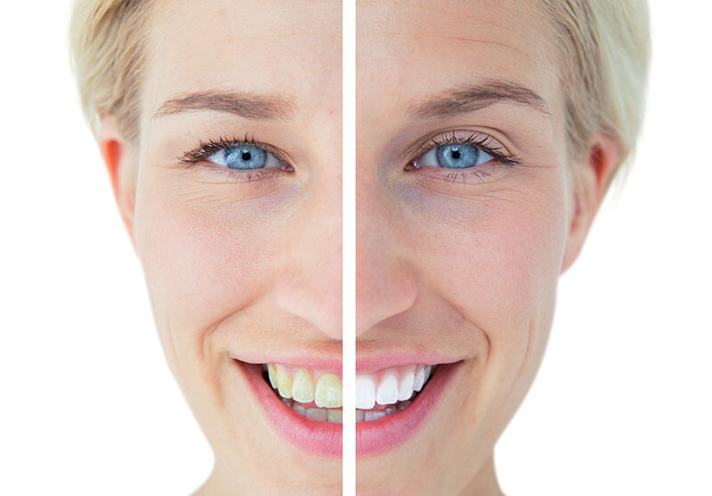 Teeth Whitening