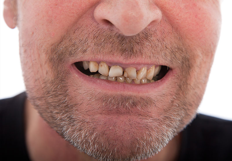 Broken-Teeth