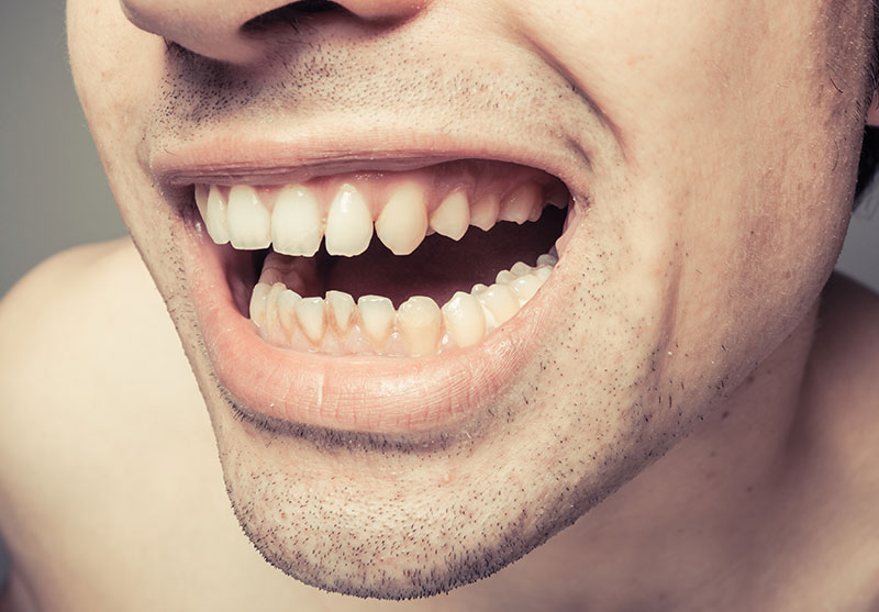 Dental-Abscess
