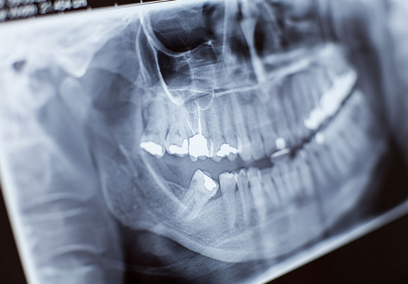 Impacted-Wisdom-Teeth