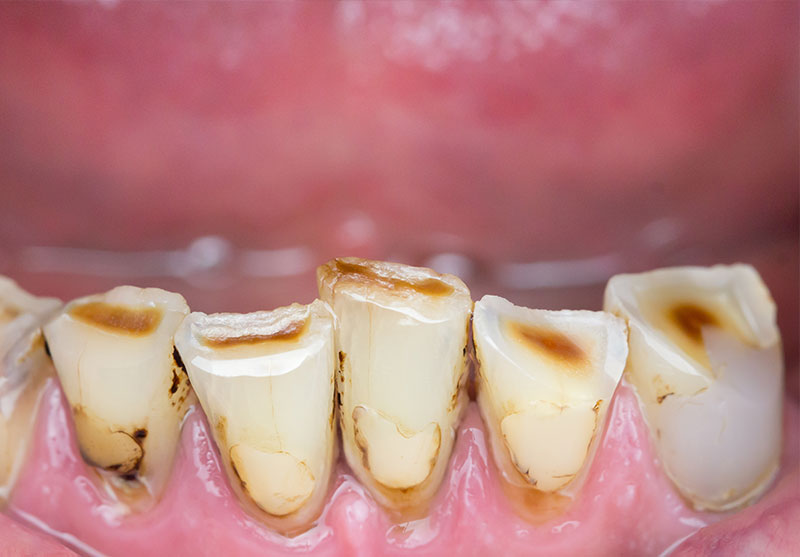 worn-teeth