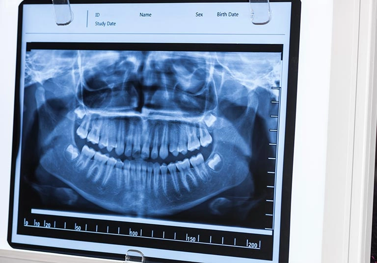Dental Xray Toowoomba & Pittsworth - The Avenue Dental
