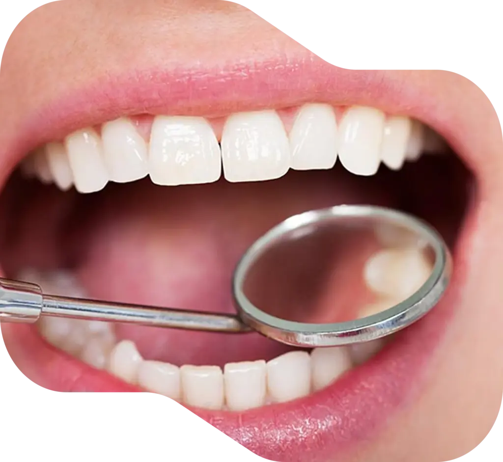 Fissure Seals Toowoomba & Pittsworth - The Avenue Dental